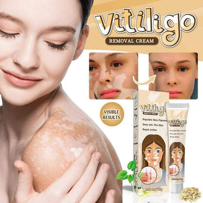 Vitiligo Removal Cream